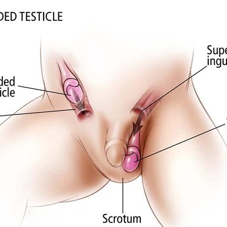 Cryptorchidism