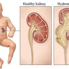 Fetal hydronephrosis
