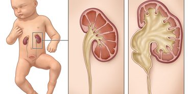 Fetal hydronephrosis