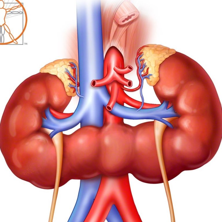 Horseshoe Kidney