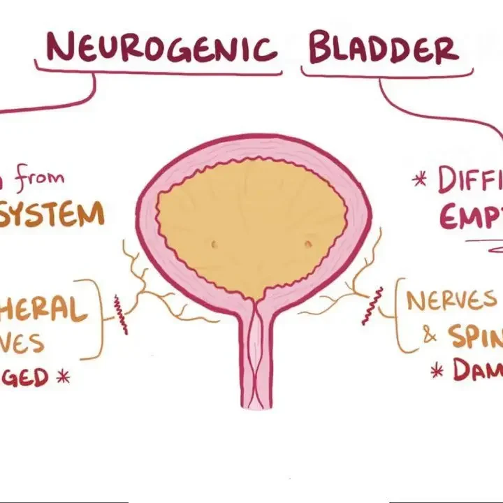 Neurogenic bladder