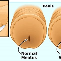 babies-urethral-stricture