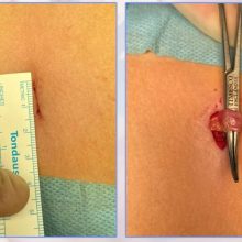 هرنی کشاله ران