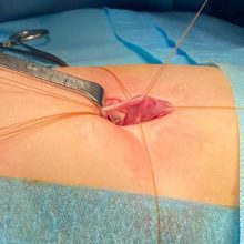 جراحی پیلوپلاستی