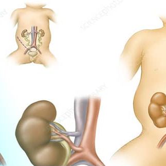 unilateral renal agenesis