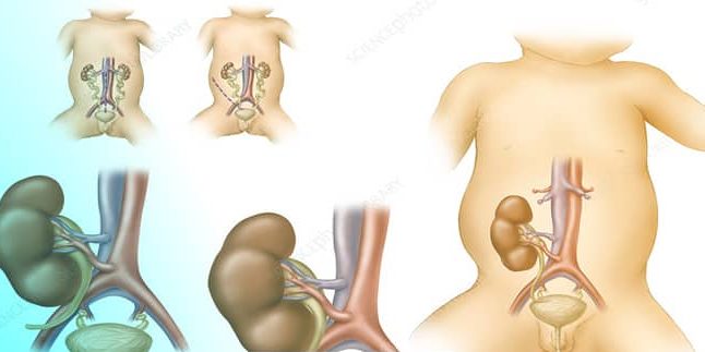 unilateral renal agenesis