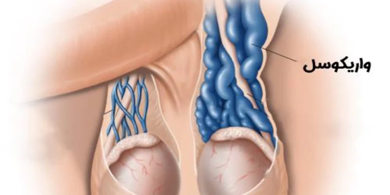 varicocele
